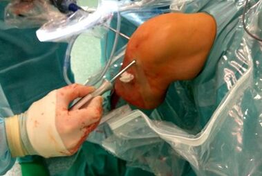 Intervención cirúrxica para a artrose