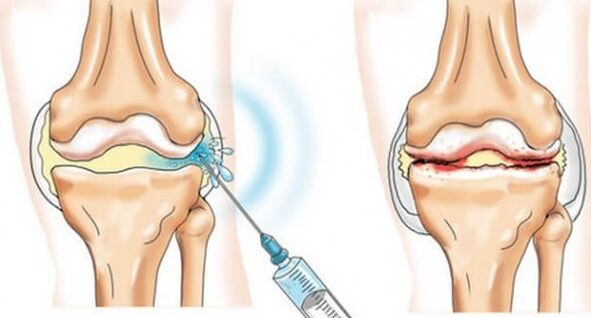 Medidas médicas para a artrose